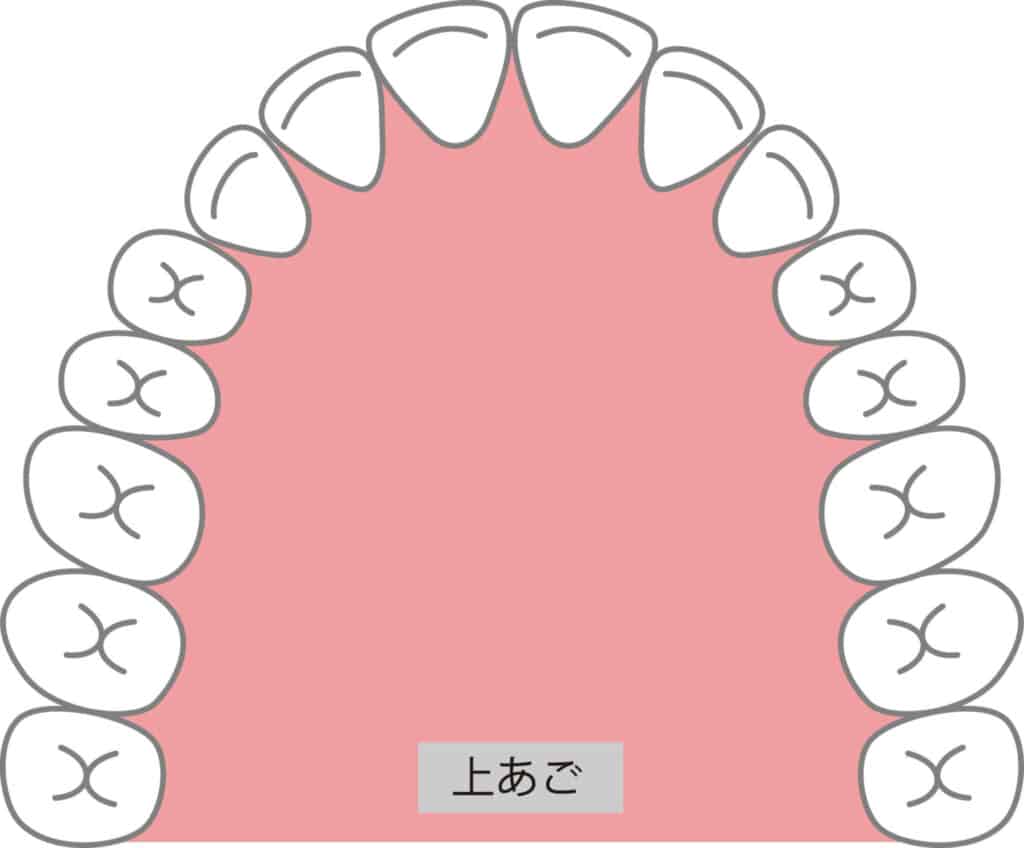 上顎のアーチ