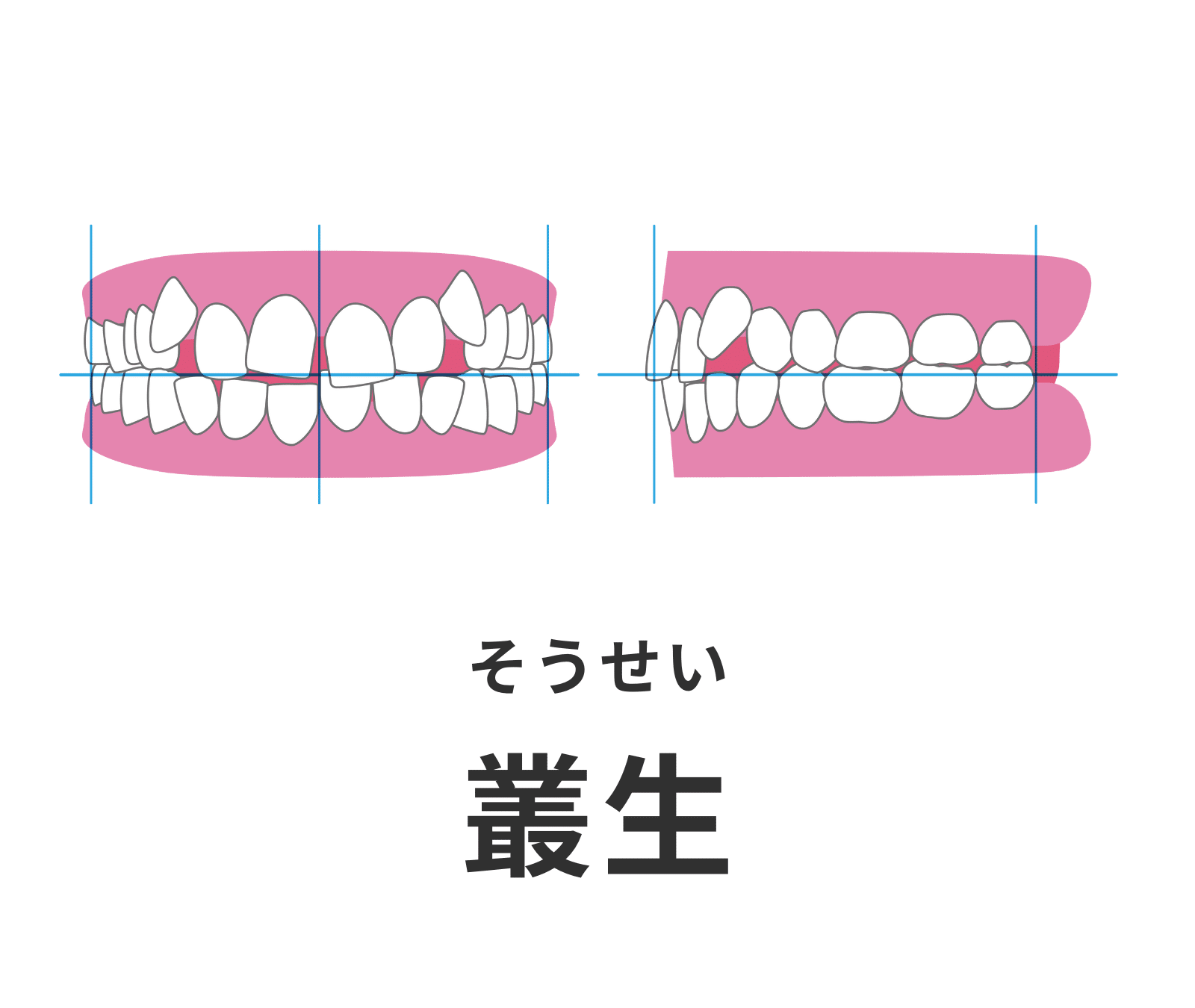 叢生_乱杭_デコボコ_矯正_小児矯正