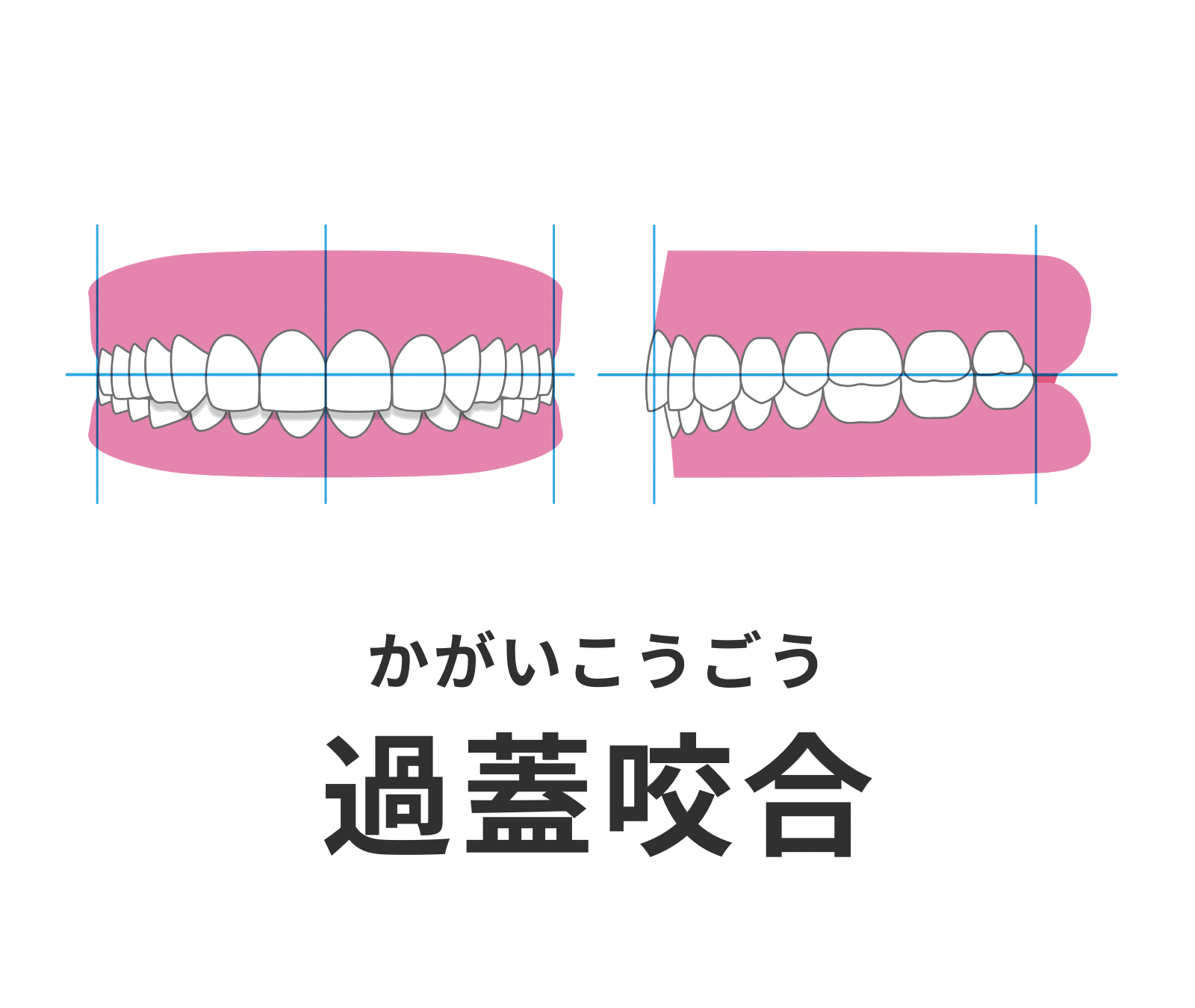 過蓋咬合_ディープバイト_矯正_小児矯正