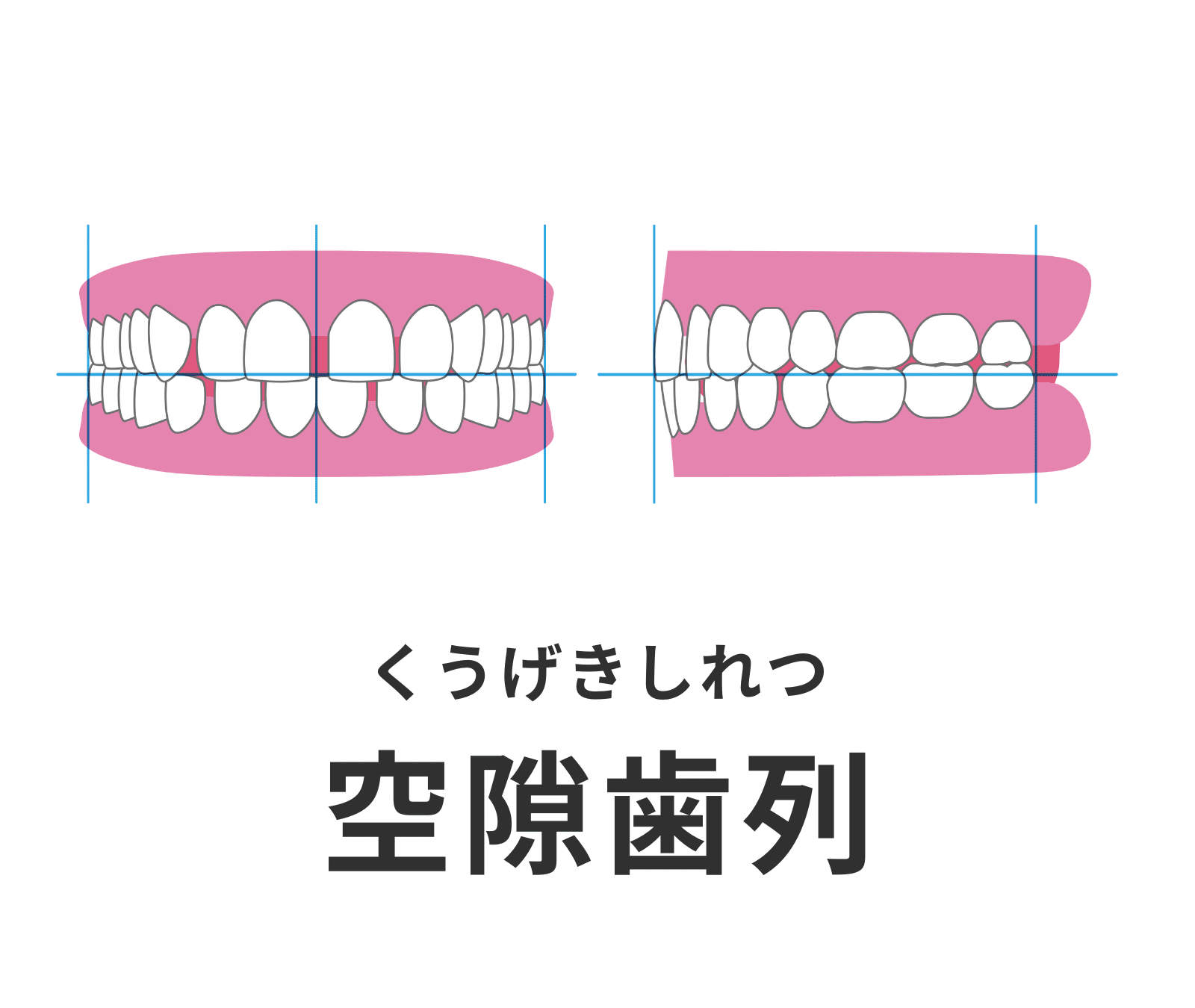 空隙歯列_矯正_小児矯正