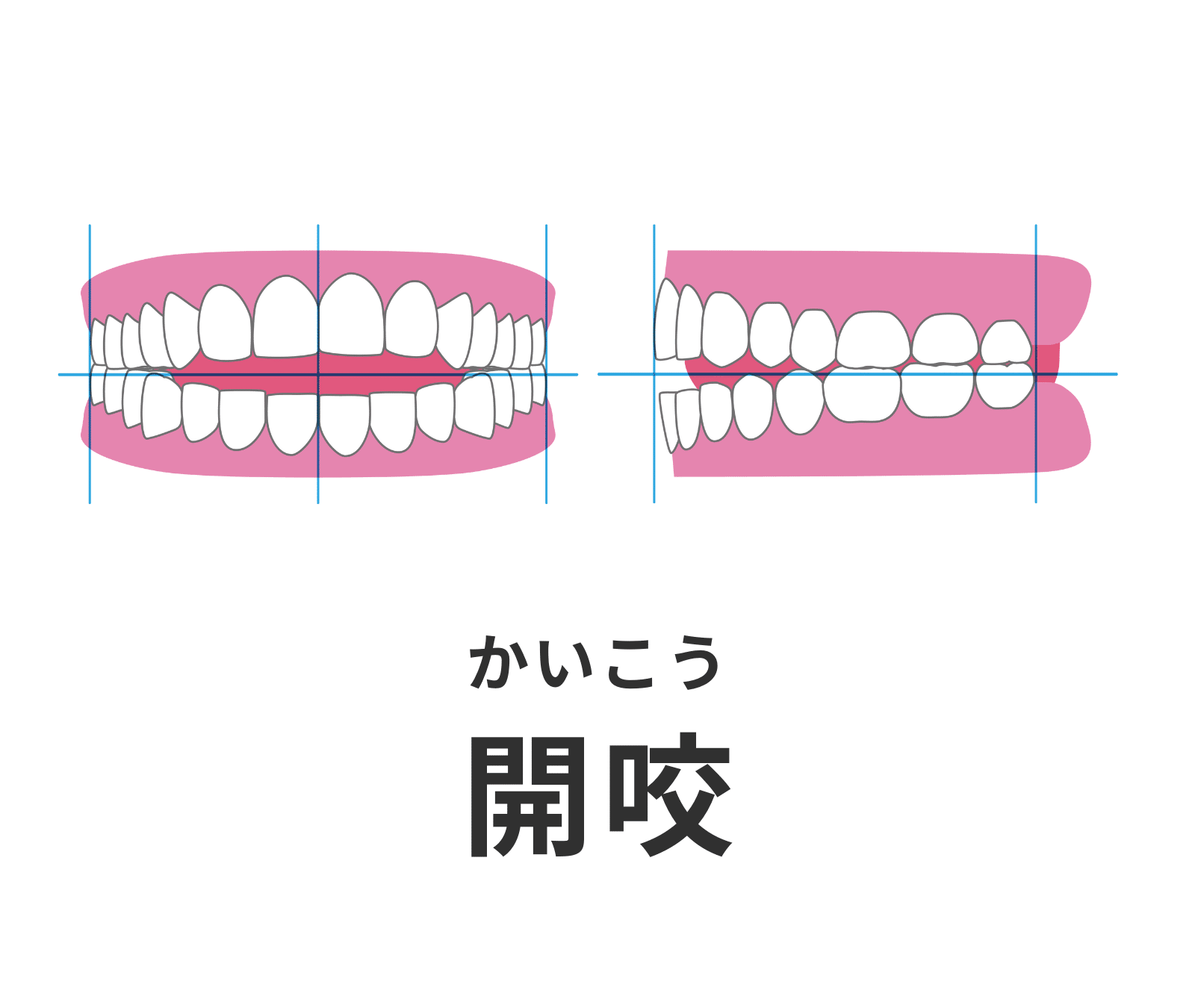 開咬_オープンバイト_矯正_小児矯正