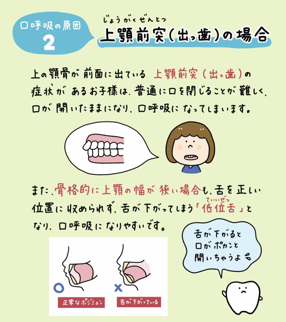 子供は生まれた時は鼻呼吸_3_口をポカンと開けた子どもと鼻呼吸する子どもの解説イラスト。原因・リスク・改善法を示す図解。