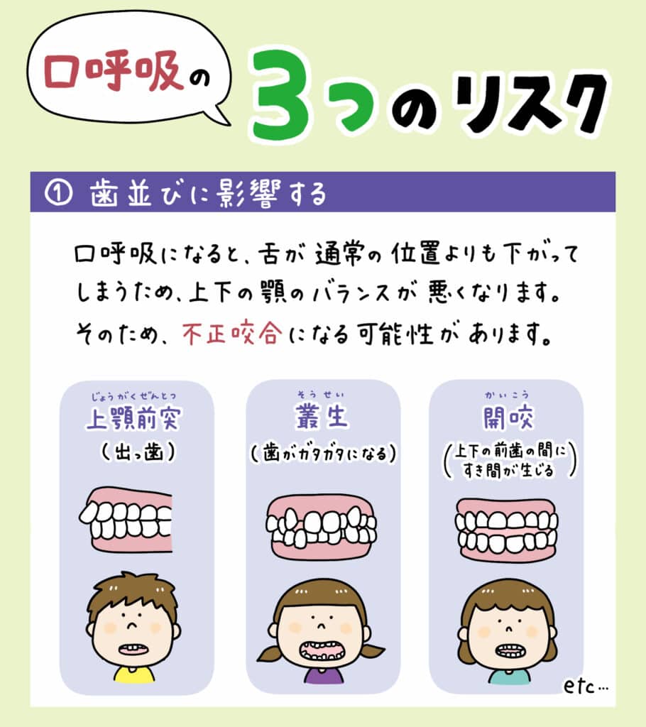 子供は生まれた時は鼻呼吸_7_口をポカンと開けた子どもと鼻呼吸する子どもの解説イラスト。原因・リスク・改善法を示す図解。