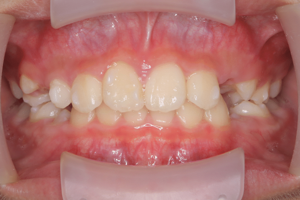 上顎前突（10歳7ヶ月）開始後0ヶ月