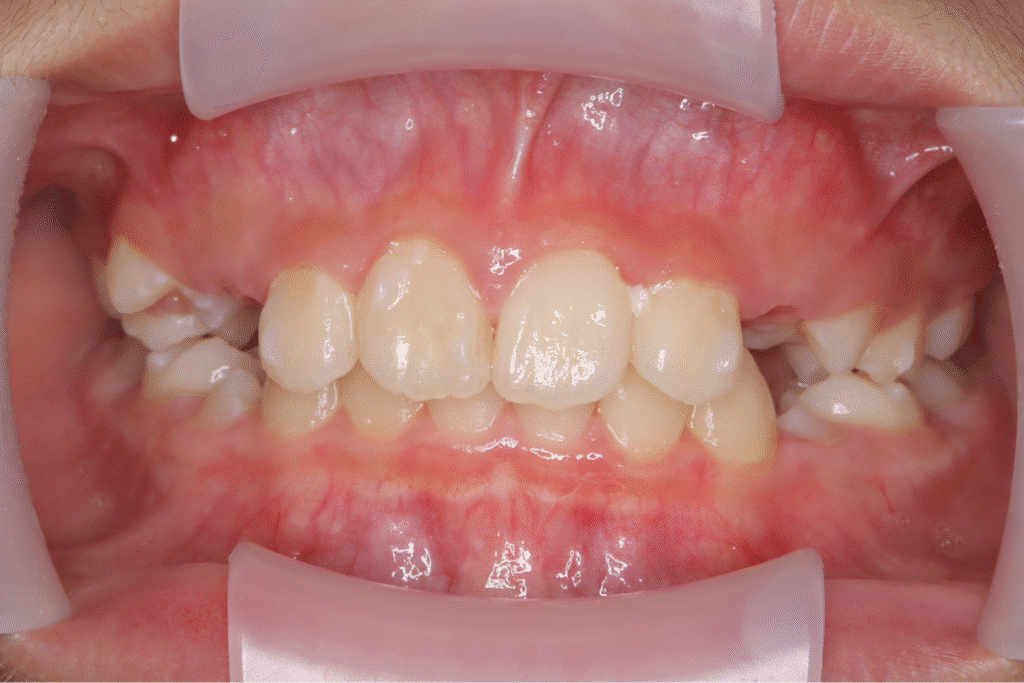 上顎前突（10歳8ヶ月）開始後0ヶ月