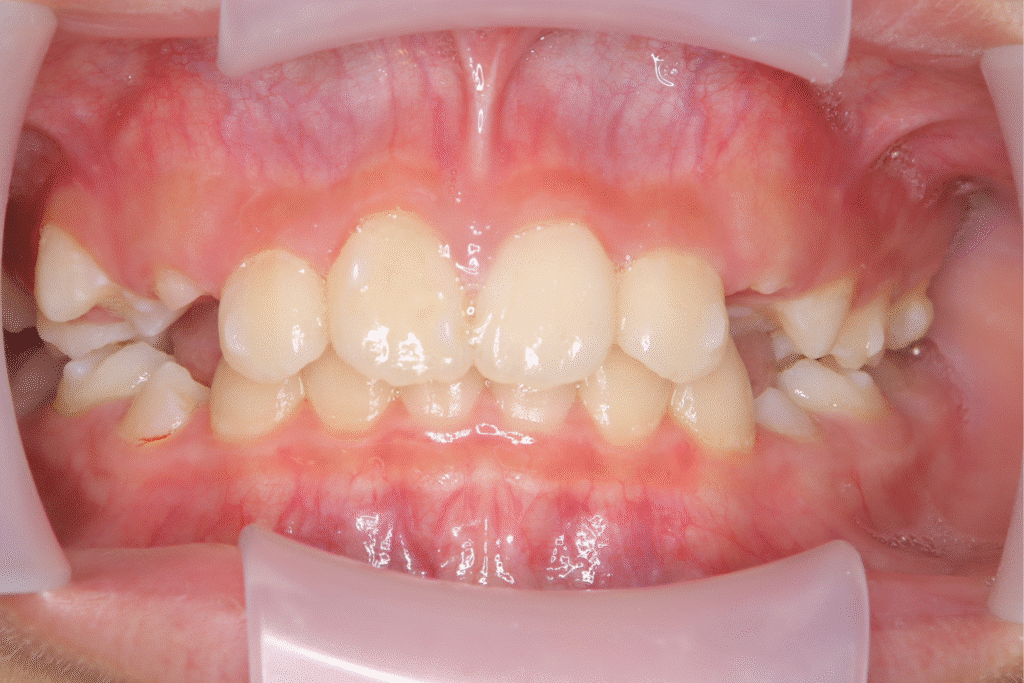 上顎前突（10歳9ヶ月）開始後2ヶ月