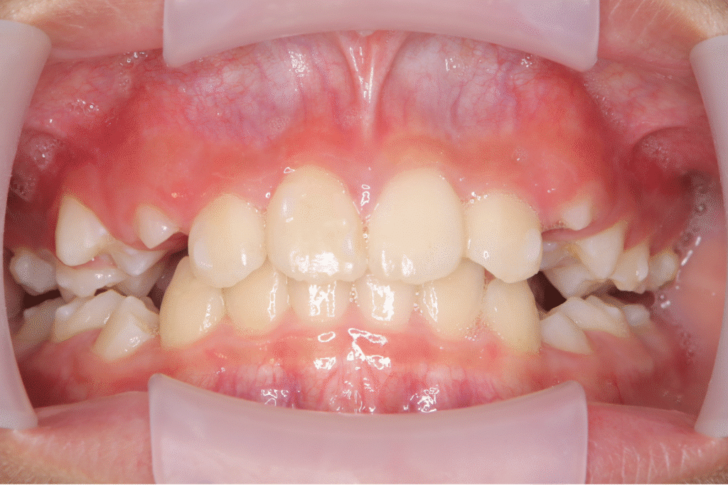 上顎前突（10歳11ヶ月）開始後3ヶ月