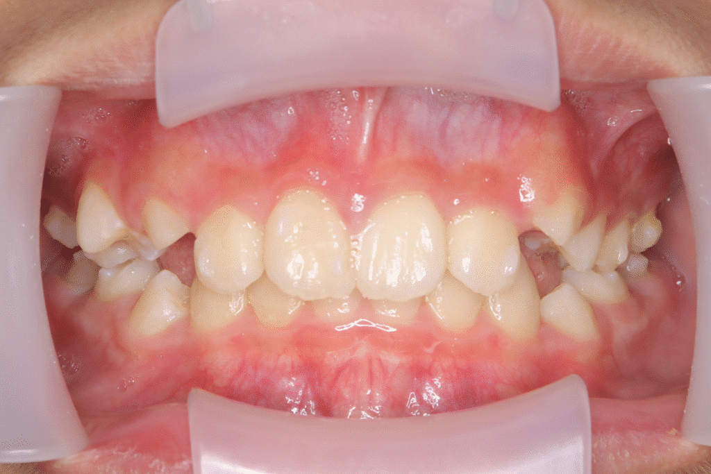 上顎前突（11歳0ヶ月）開始後5ヶ月