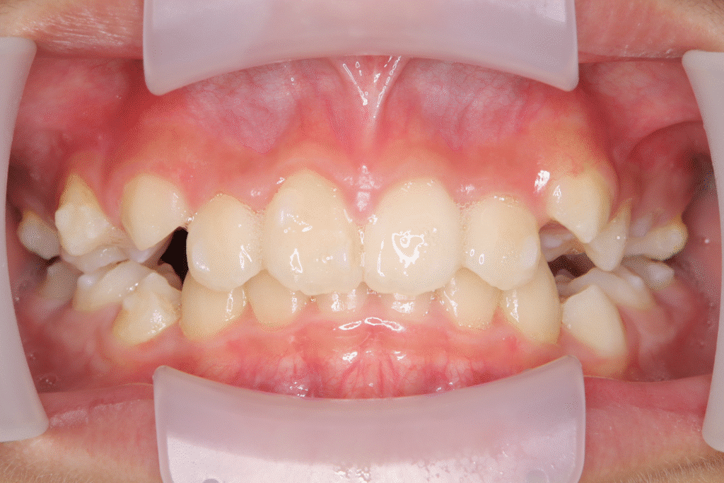 上顎前突（11歳2ヶ月）開始後6ヶ月