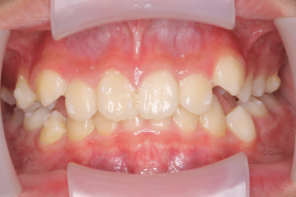 上顎前突（11歳4ヶ月）開始後9ヶ月