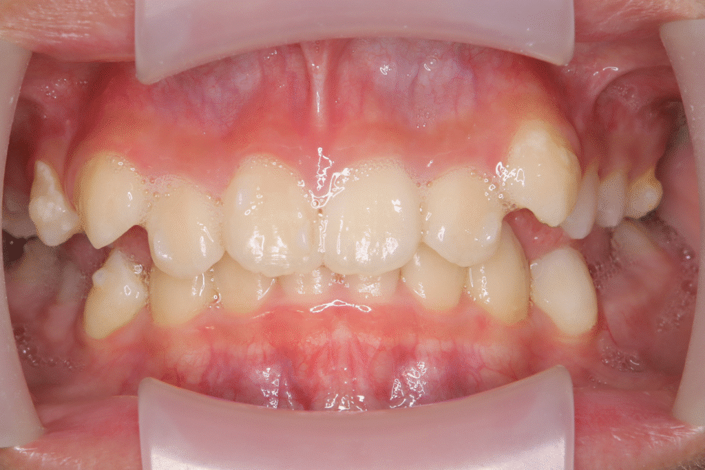 上顎前突（11歳7ヶ月）開始後11ヶ月