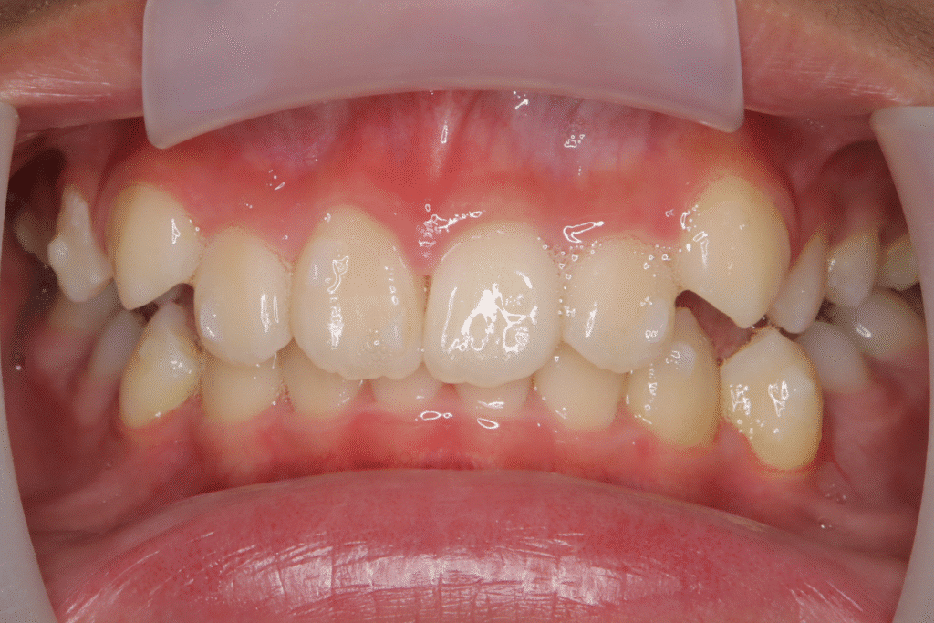 上顎前突（11歳8ヶ月）開始後12ヶ月