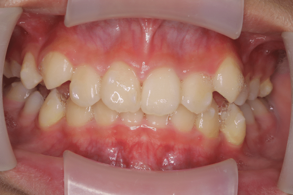 上顎前突（11歳9ヶ月）開始後14ヶ月