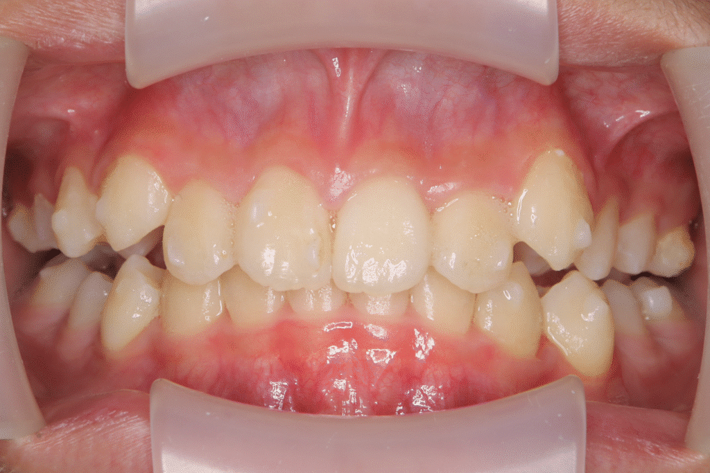 上顎前突（12歳0ヶ月）開始後16ヶ月