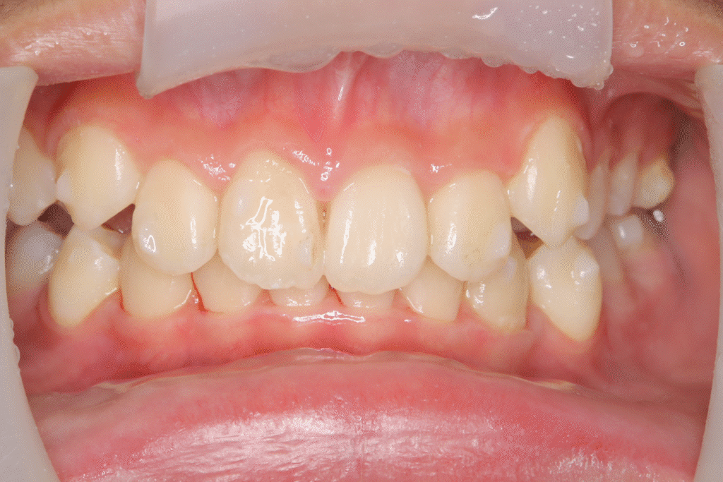 上顎前突（12歳2ヶ月）開始後18ヶ月