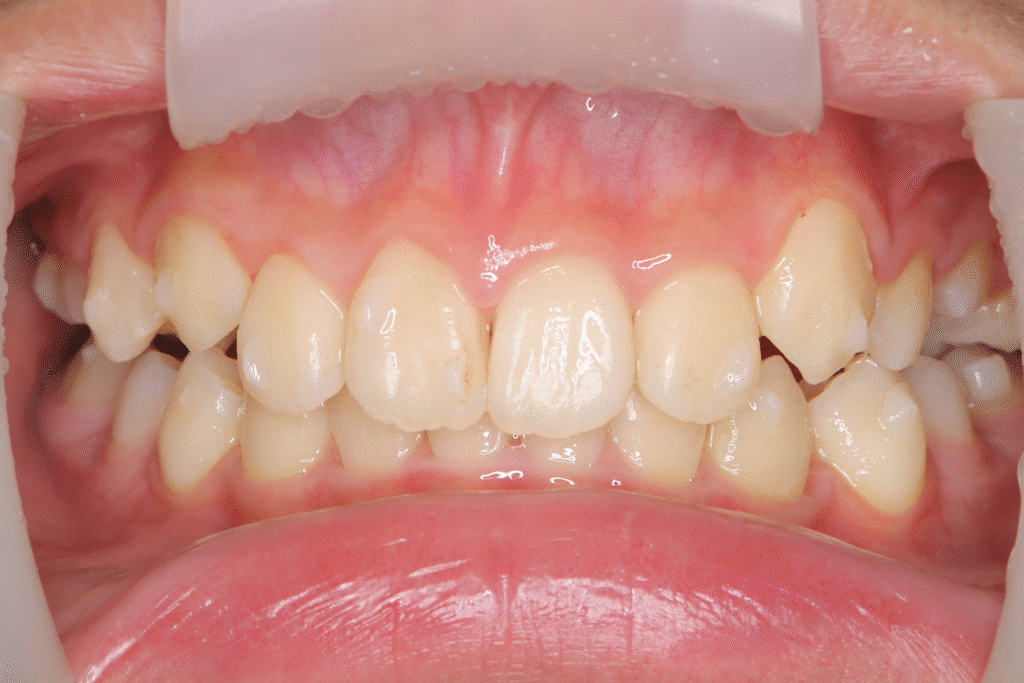 上顎前突（12歳4ヶ月）開始後20ヶ月