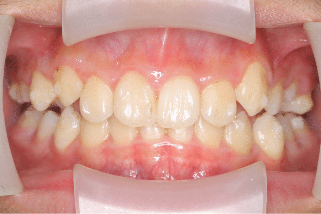 上顎前突（12歳5ヶ月）開始後21ヶ月