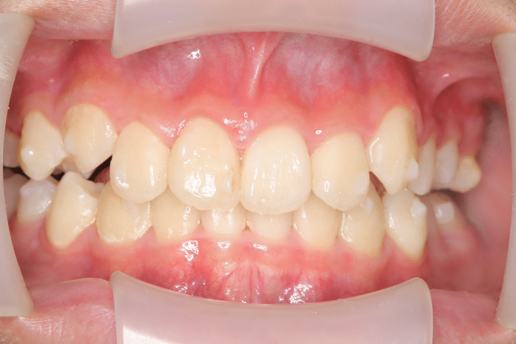 上顎前突（12歳8ヶ月）開始後24ヶ月