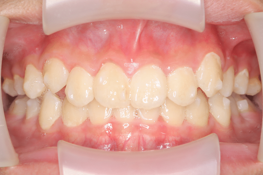 上顎前突（12歳9ヶ月）開始後26ヶ月