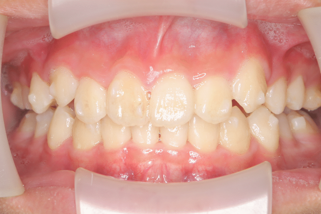 上顎前突（12歳11ヶ月）開始後27ヶ月