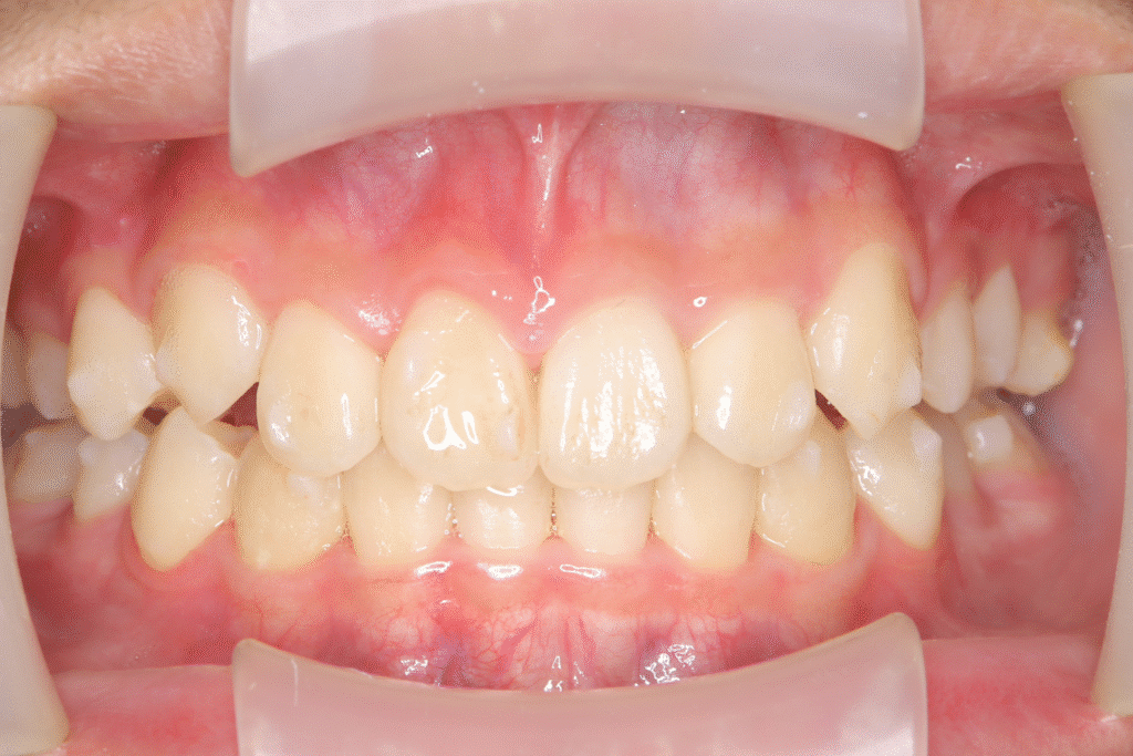 上顎前突（13歳1ヶ月）開始後29ヶ月