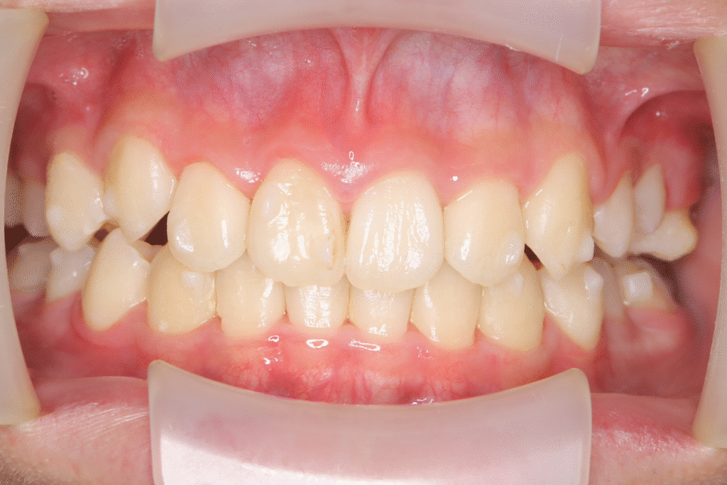 上顎前突（13歳2ヶ月）開始後31ヶ月