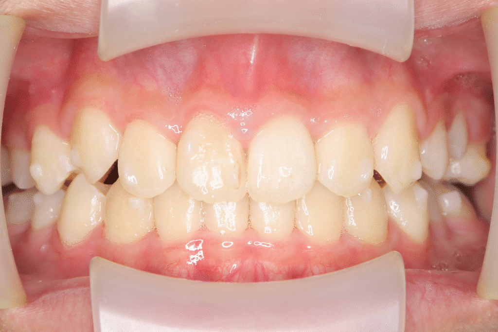 上顎前突（13歳3ヶ月）開始後33ヶ月