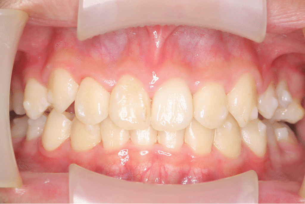 上顎前突（13歳4ヶ月）開始後34ヶ月