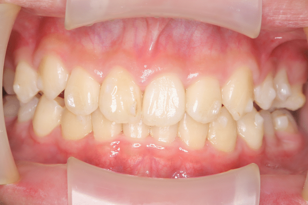 上顎前突（13歳5ヶ月）開始後35ヶ月