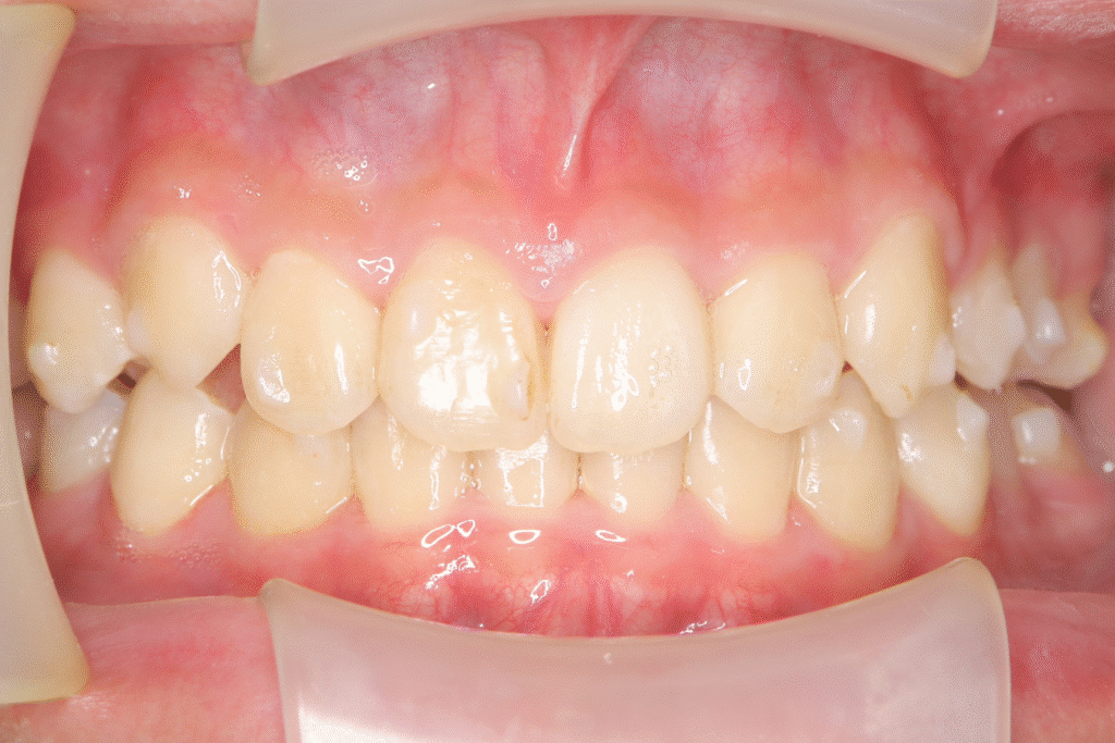 上顎前突（13歳7ヶ月）開始後36ヶ月