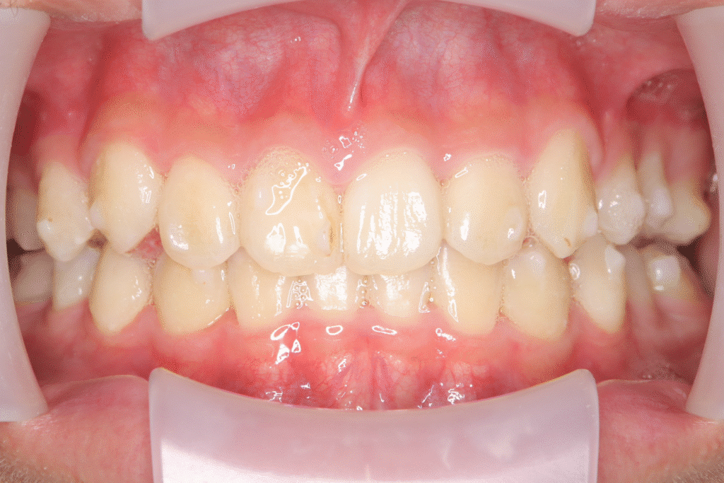 上顎前突（13歳8ヶ月）開始後37ヶ月