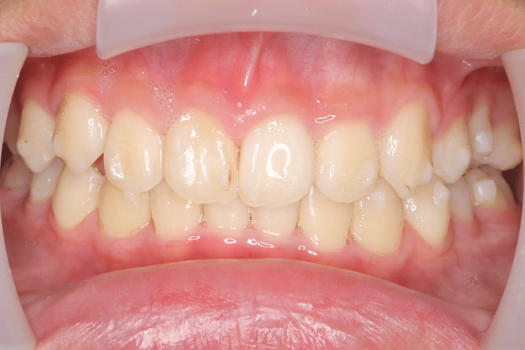 上顎前突（13歳9ヶ月）開始後39ヶ月