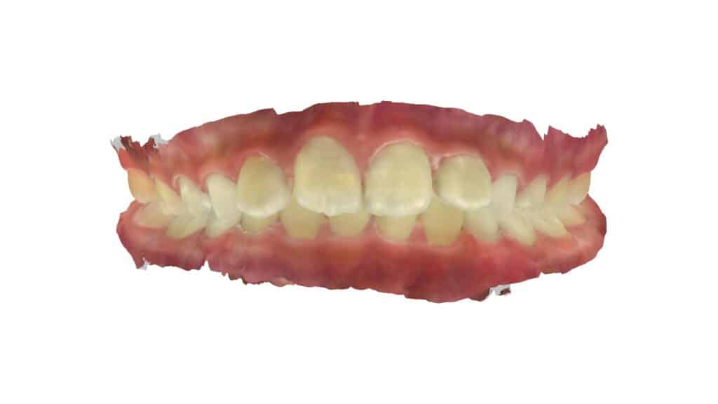上顎前突（9歳7ヶ月）開始前12ヶ月前