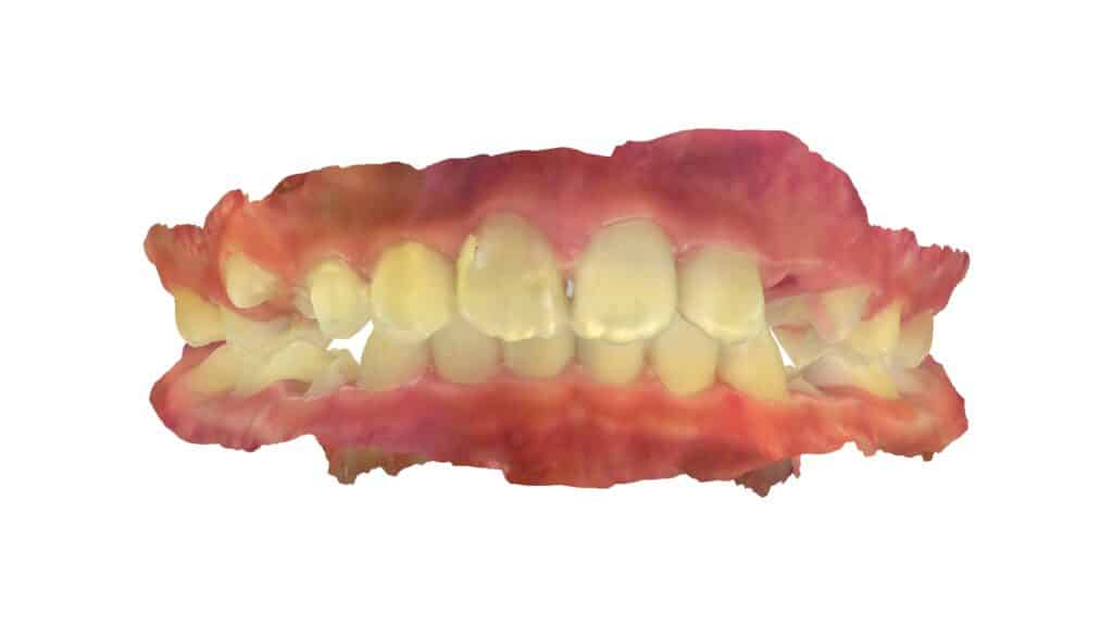 上顎前突（10歳7ヶ月）開始後0ヶ月