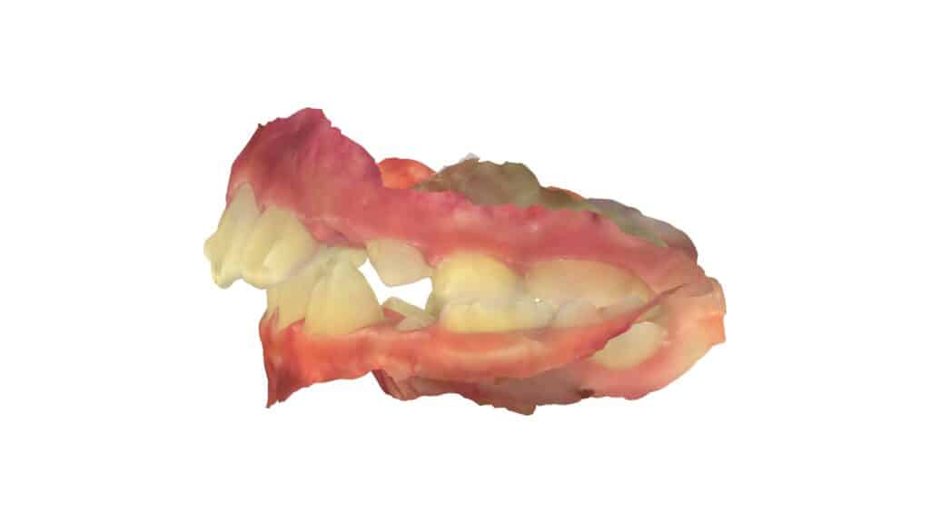 上顎前突（10歳7ヶ月）開始後0ヶ月