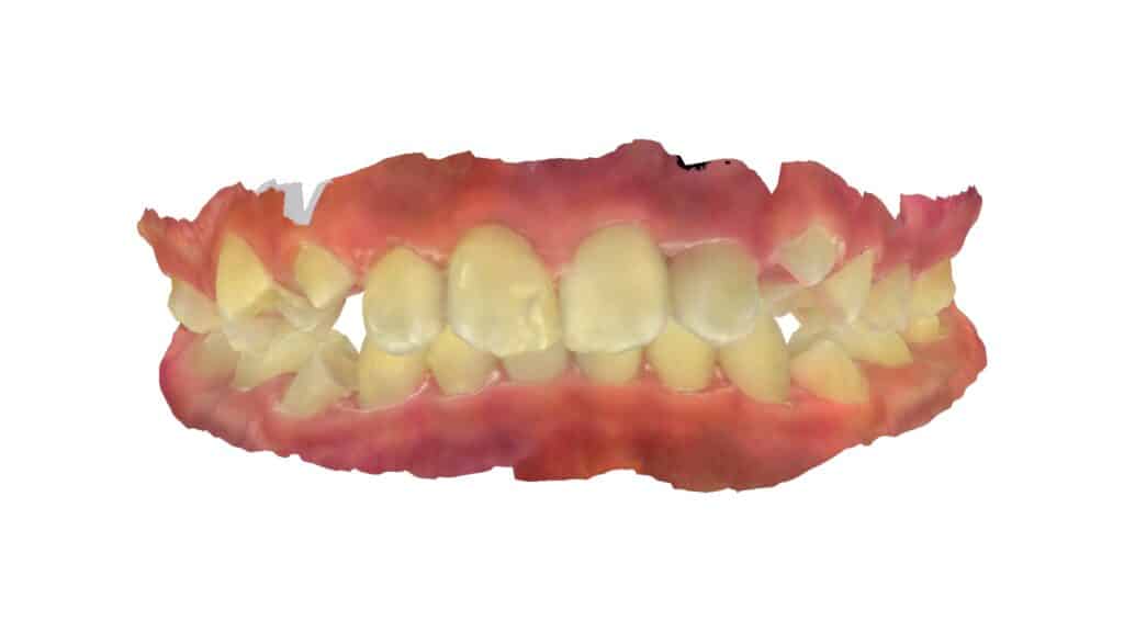 上顎前突（11歳0ヶ月）開始後5ヶ月