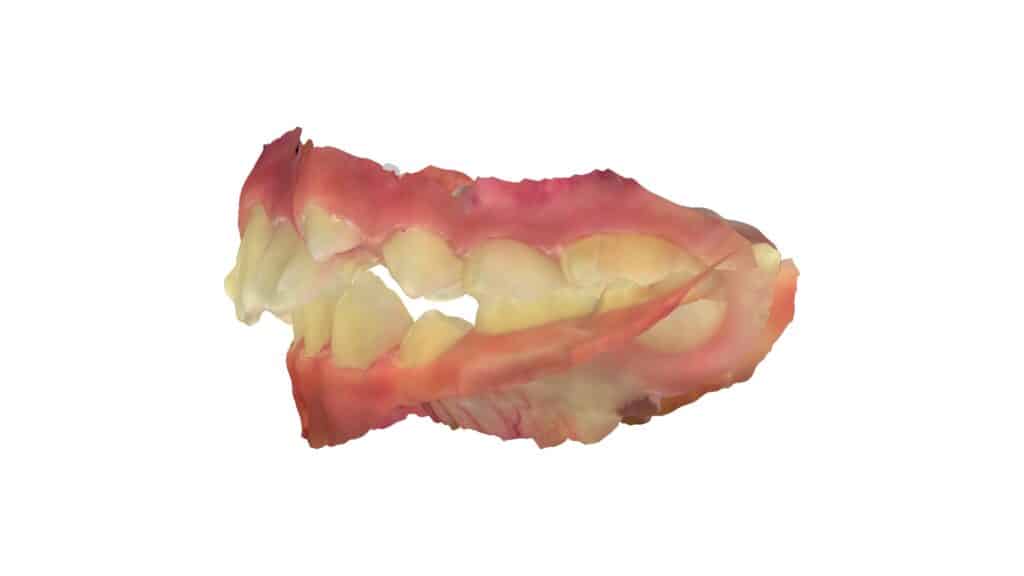 上顎前突（11歳0ヶ月）開始後5ヶ月