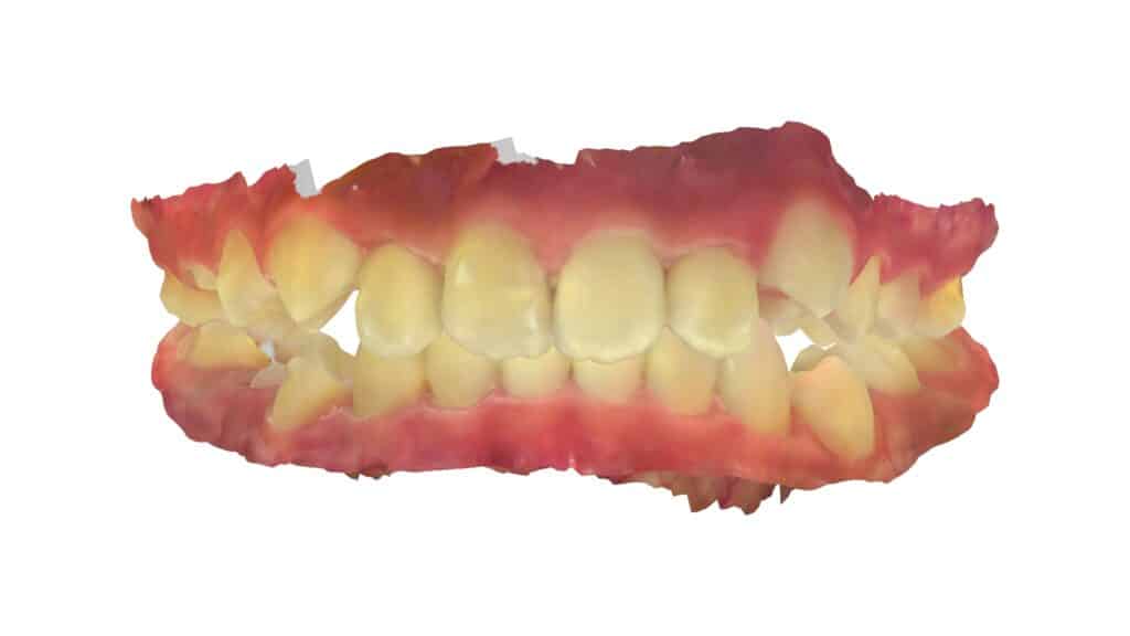 上顎前突（11歳5ヶ月）開始後10ヶ月