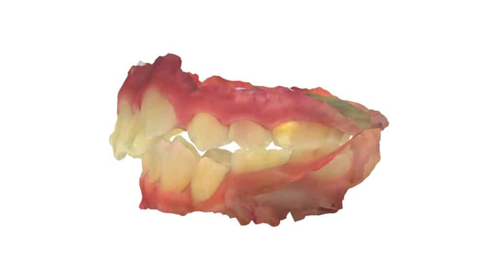 上顎前突（11歳5ヶ月）開始後10ヶ月