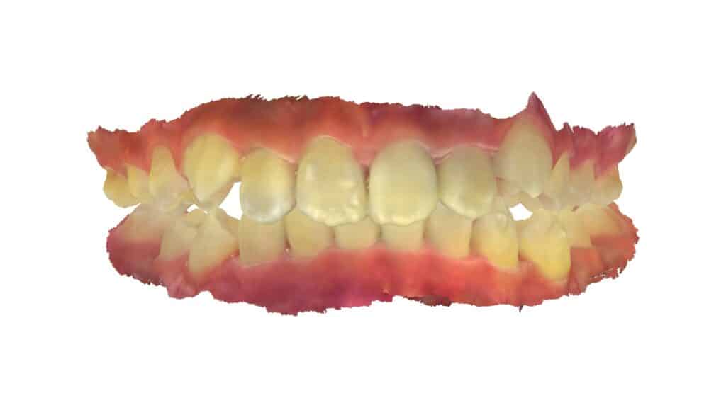 上顎前突（11歳9ヶ月）開始後14ヶ月