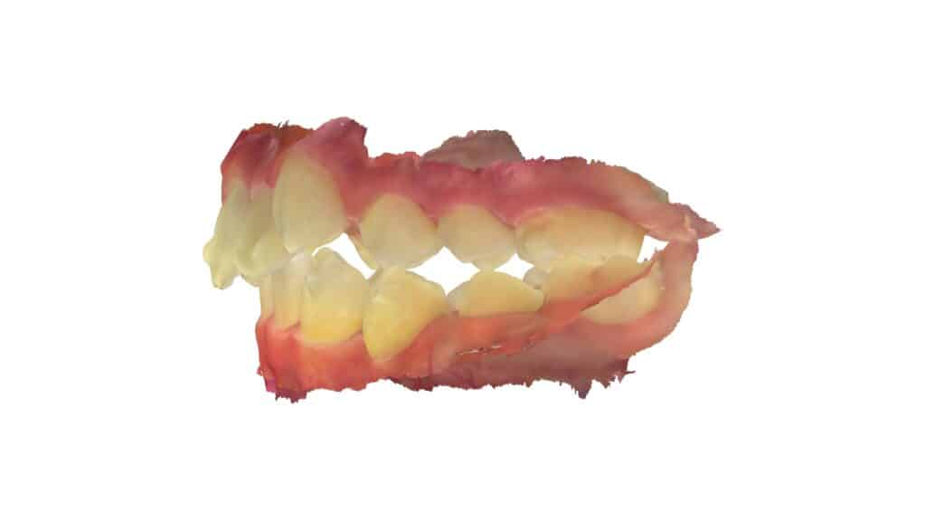 上顎前突（11歳9ヶ月）開始後14ヶ月