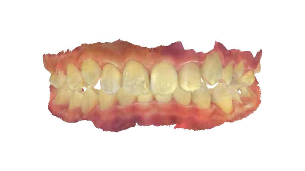 上顎前突（12歳4ヶ月）開始後20ヶ月