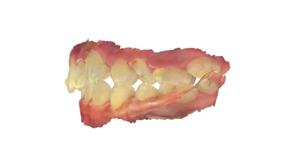 上顎前突（12歳4ヶ月）開始後20ヶ月