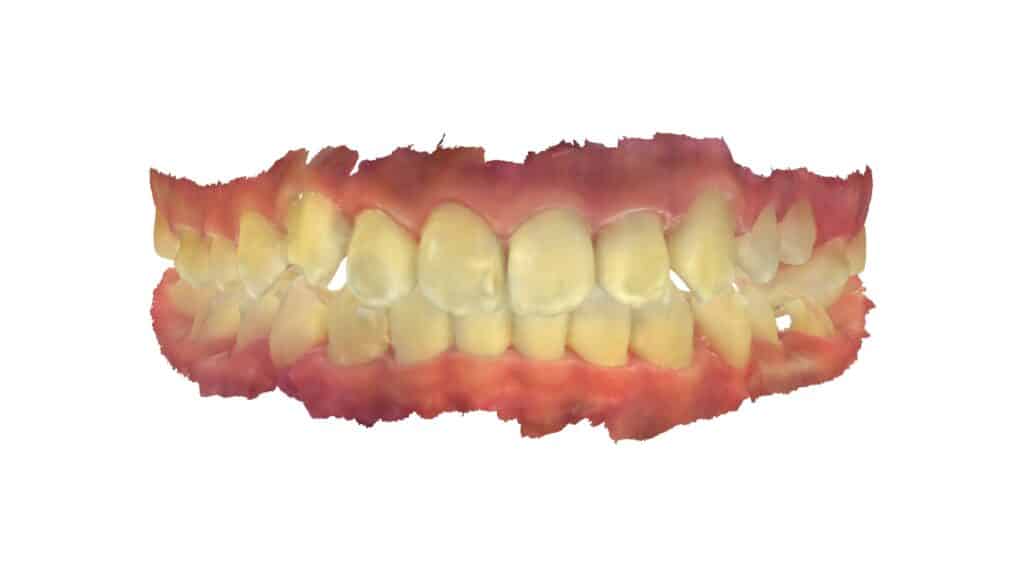 上顎前突（13歳2ヶ月）開始後31ヶ月
