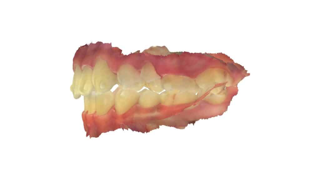 上顎前突（13歳2ヶ月）開始後31ヶ月