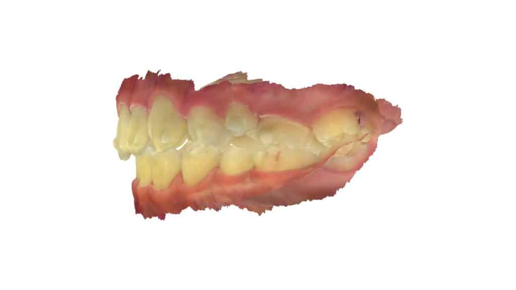 上顎前突（13歳9ヶ月）開始後39ヶ月